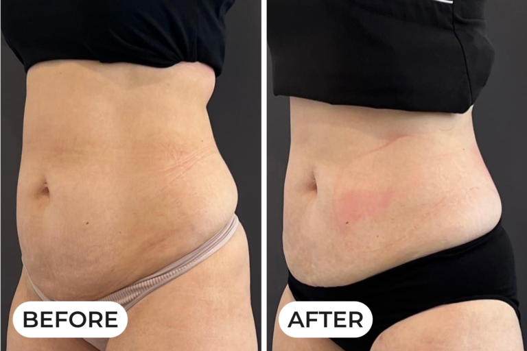 What Is Emsculpt NEO and How Does It Work in Scottsdale?